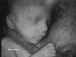 Причины обвития пуповиной Однократное обвитие пуповиной