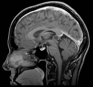 Тяжесть заболевания Степень забоелвания