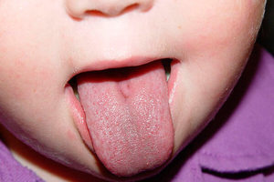 Пятна на языке у ребенка Пятна на языке у ребенка
