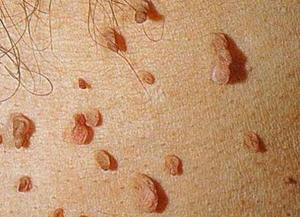 Вирус папилломы Вирус папилломы человека