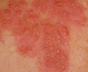 Герпес опоясывающий на теле Как лечить герпес народными средствами