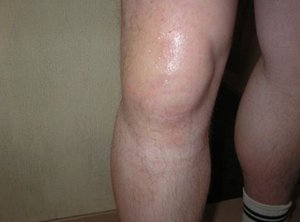 Причины болей в коленях Боли в коленных суставов