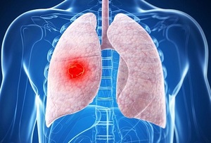 Причины возникновения опухолей Почему возникают опухоли