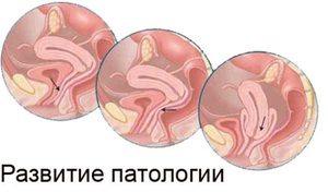 Неоперативные способы лечения выпадения матки Симптомы выпадения матки у женщин пожилого возраста