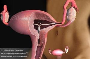 Осложнения после введения спирали Осложнения после введения внутриматочной спирали