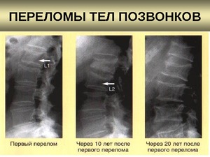 Компрессионный перелом позвоночника 1 степени Компрессионный перелом позвоночника 1-й степени