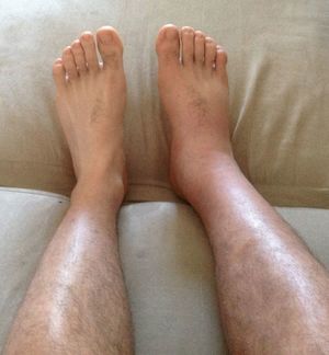 Методы лечения отека ног Если отекли ноги, что делать