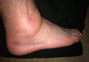 Народные способы лечения отеков ног Народные методы лечения отека ног