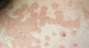 Лишай у человека: причины, признаки и симптомы, лечение Признаки лишая у человека