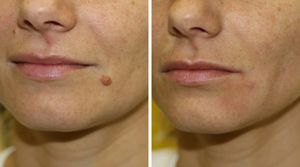 Образование у женщин Образование у женщин на коже лица