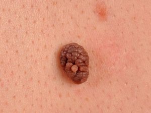 Лечение невусов Папилломатозная невус на коже