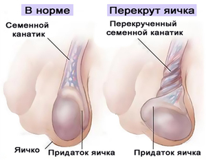 Что приводит к боли в яичках Симптомы азболеваний
