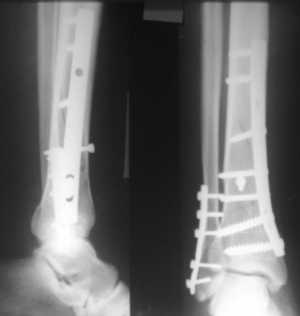 Хирургическое вмешательство при лечении травмы лодыжки со смещением Перелом наружной лодыжки