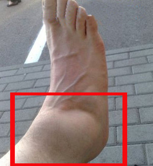 Причины перелома голеностопа со смещением Когда можно наступать на ногу при переломе голеностопа