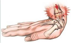 Перелом лучезапястного сустава со смещением Перелом лучезапястного сустава без смещения