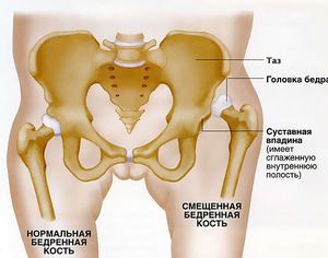 Сравнение нормального и смещенного бедра Как выглядит перелом бедра со смещением