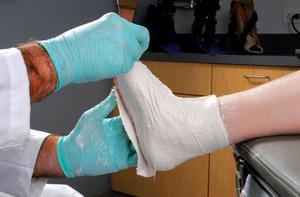 Перелом голеностопного сустава со смещением Лечение перелома лодыжки