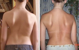 Степени сколиоза Степень тяжести заболевания сколиоз