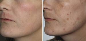 Какие есть средства от избавления от пятен Косметические средлства от прыщей