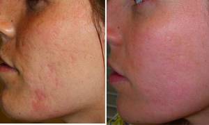 Угревая сыпь Угревая сыпь на лице
