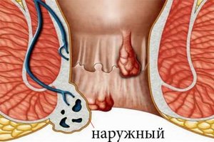 Группа риска Кто подвержен появлению геморроя