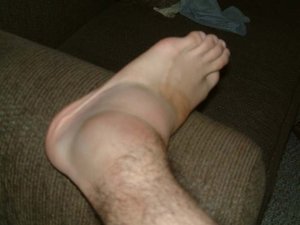 Отек ног в области щиколотки Чем лечить отек ног