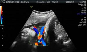 Диагностика патологии Внутриутробная обвитие пуповиной