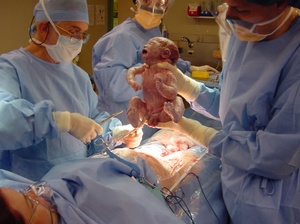 Кесарево сечение Когда делается кесарево сечение