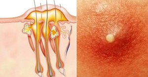 Левомеколь от фурункулов Лечит ли мазь Левомеколь фурункулы