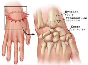 Реабилитация после перелома лучевой кости лфк после перелома лучевой кости со смещением