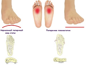 Консервативное лечение Лечение с помощью гимнастики