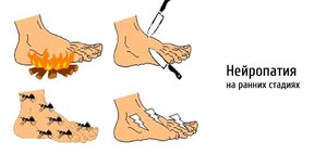 Диабетическая нейропатия Симптомы нейропатии