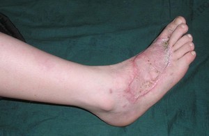 Причины вызвавшие заболевание Виды нейропатии