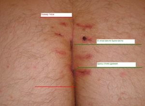 Основные симптомы копчиковой кисты Как выглядит копчиковая киста