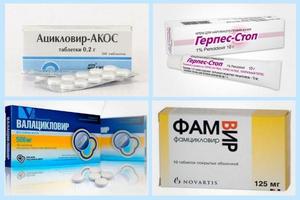 Диагностика заболевания Заболевания герпе и его виды