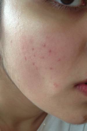 Косметологические процедуры Причины пятен на лице после прыщей