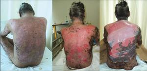 Причины возникновения болезни Лайелла Возможные причины появления болезни Лайелла