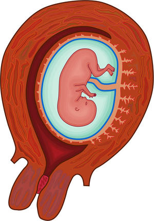 Диагностика нарушений плодового плацентарного кровотока Особенности протекания нарушения маточного плацентарного кровотока