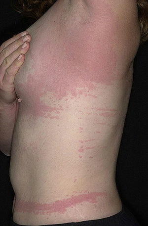 Основные виды лейкоза у взрослых Основные виды лейкоза