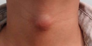 Причины образования кисты на щитовидке Из-за чего развивается киста на щитовидной железе