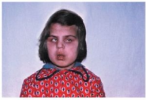 Диагностика заболевания Лечение синдрома Олбрайта