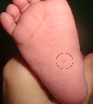 Почему появляются прыщи на ступнях маленькие прыщики на ногах сыпь