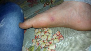 Как избавиться от прыщей на ногах Как избавиться от прыщей на ногах