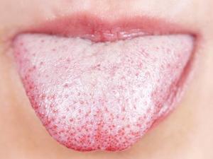 Лечение заболеваний языка Какие могут быть заболевания языка