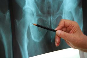 Причины развития некроза Причины развития некроза тазобедренноо сустава