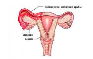 Лечение воспаления придатков антибиотиками Как лечить воспаление придатков в домашних условиях