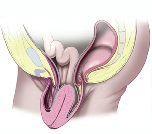 Гимнастика при выпадении матки полное выпадение матки