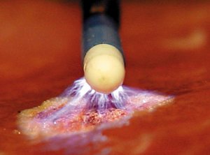 Прижигание эрозии шейки матки током Прижигание эрозии шейки матки током