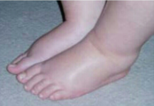 Почему отекли ноги Причины отёчности ног