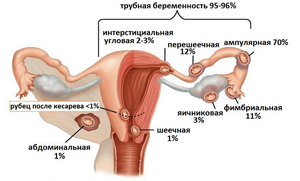 Признаки внематочной беременности Какие еще могут быть беременности